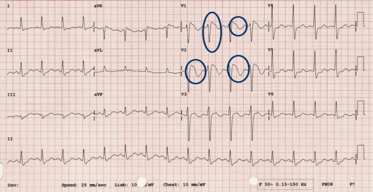 The Causes Of Brugada Syndrome And Its Symptoms Everything You Need To