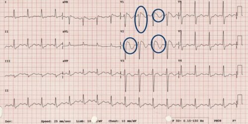 Brugada Syndrome