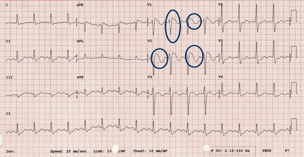 brugada type 1