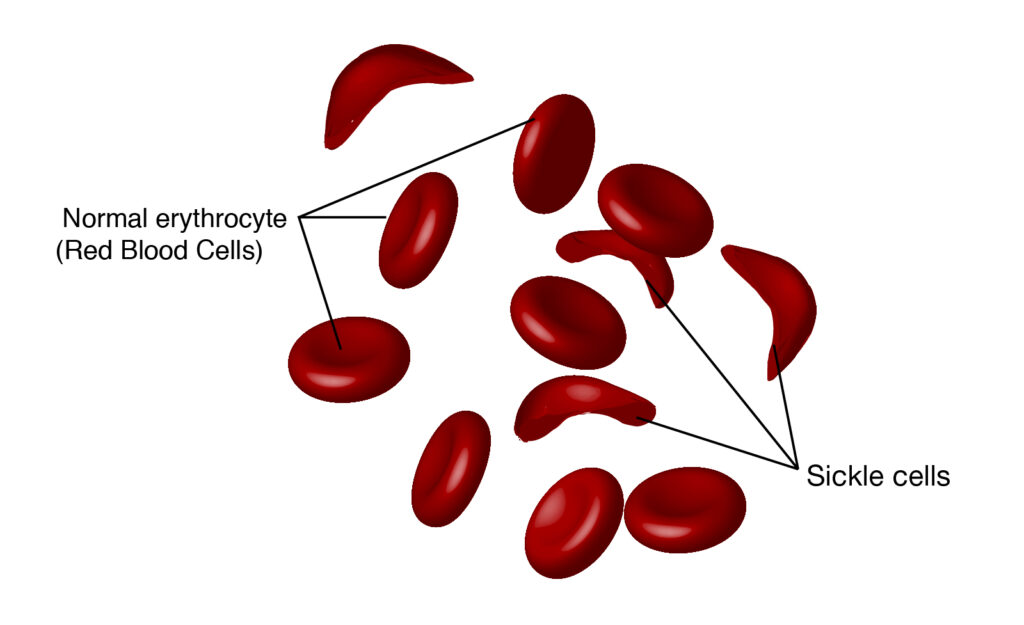 sickle cell disease sickle cell disease
