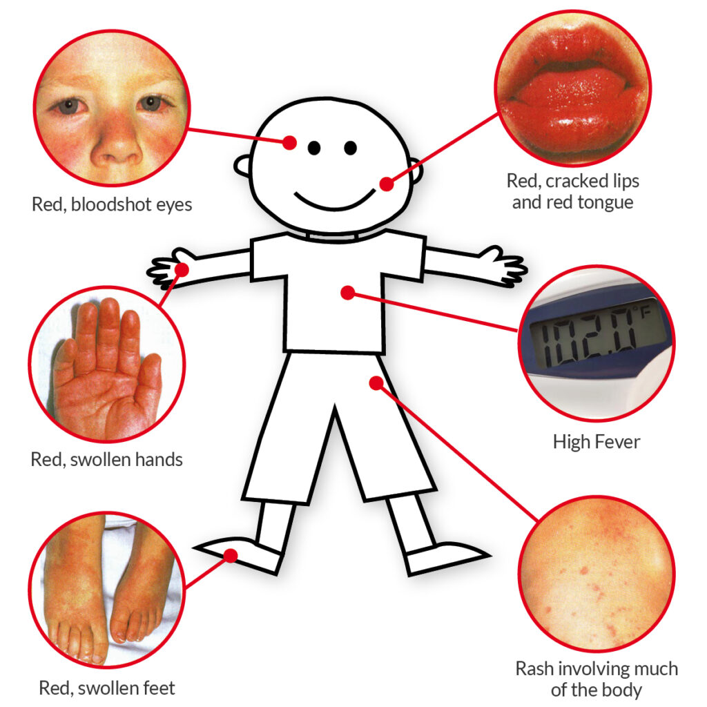 symptoms kawasaki disease 1 symptoms kawasaki disease 1
